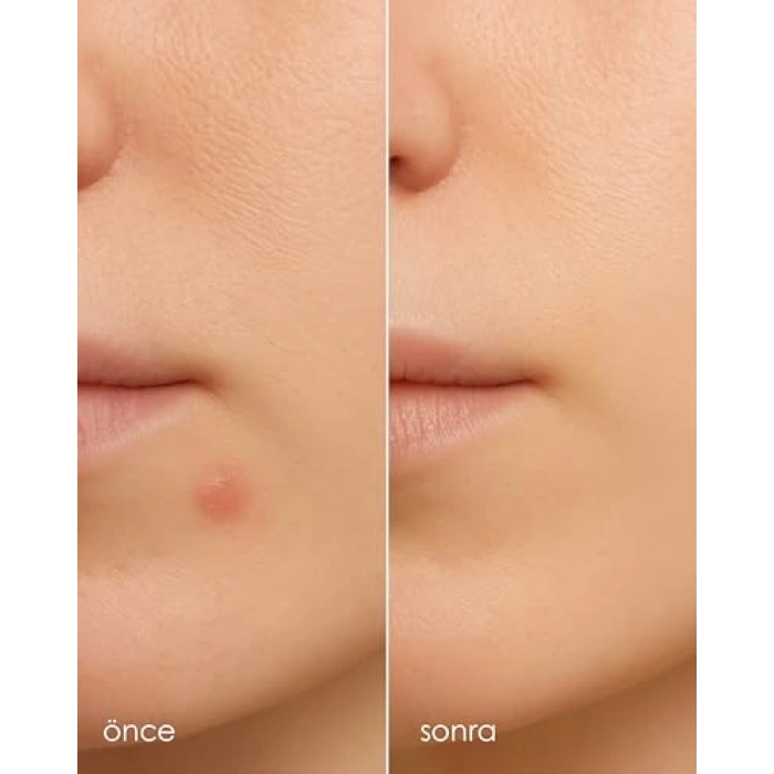 Hidrokolloid İçeren Şeffaf Akne Bandı, 24 Adet Paket