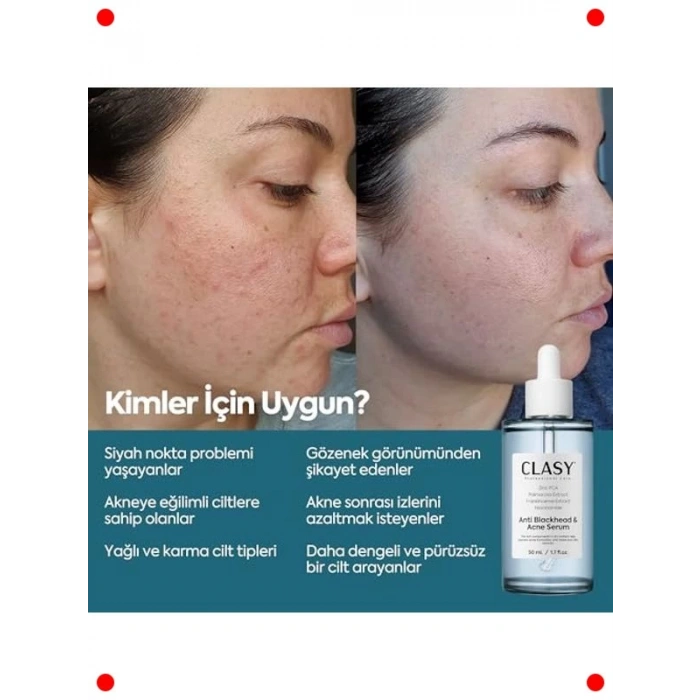 Niasinamid Akne Karşıtı & Gözenek Sıkılaştırıcı Serum