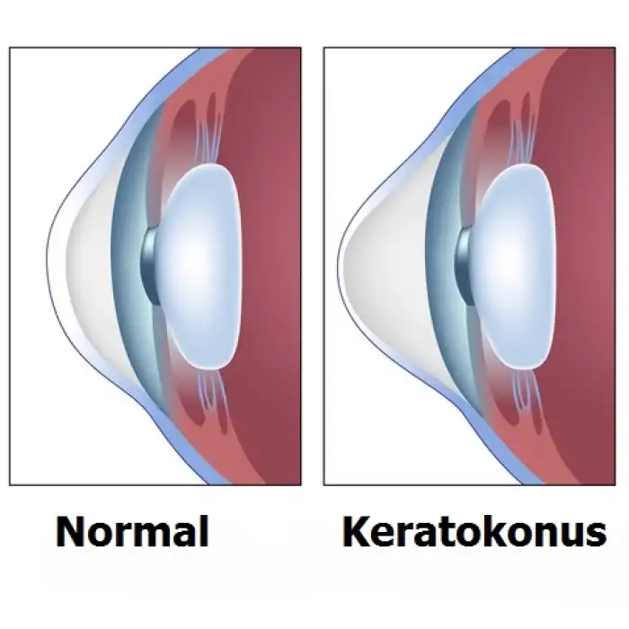 Kişiye Özel Üretim Keratokonus Lens / Keratoconus lens