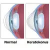 Kişiye Özel Üretim Keratokonus Lens / Keratoconus lens