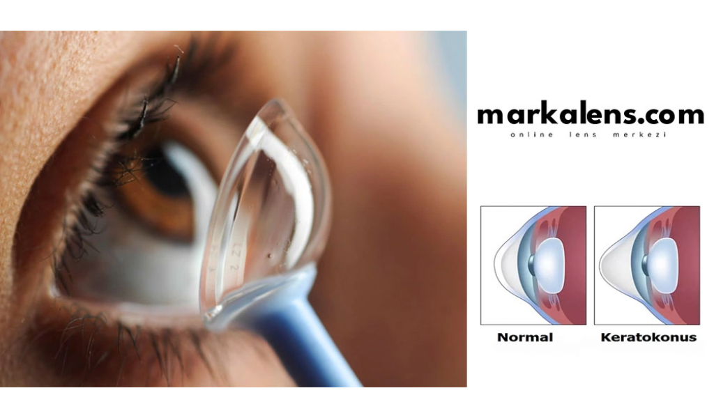 Keratokonus Lens Tedavisi Marka Lens Blog