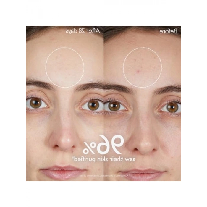 150 ml salisilik asitli temizleme jeli, akne karşıtı