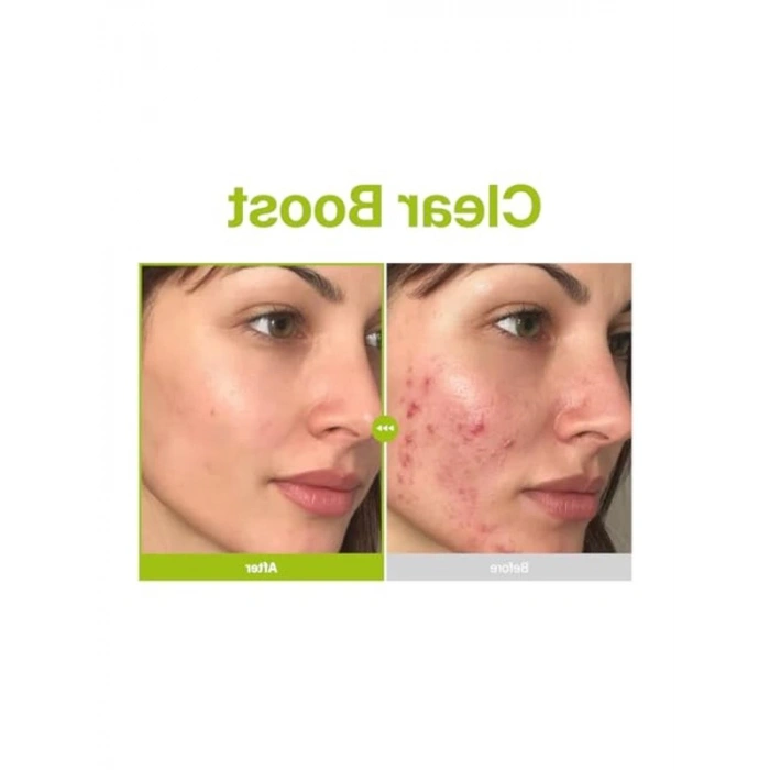 Azelaik Asit ve Kojik Asit İçeren Serum, Cilt Bakımı için Özel