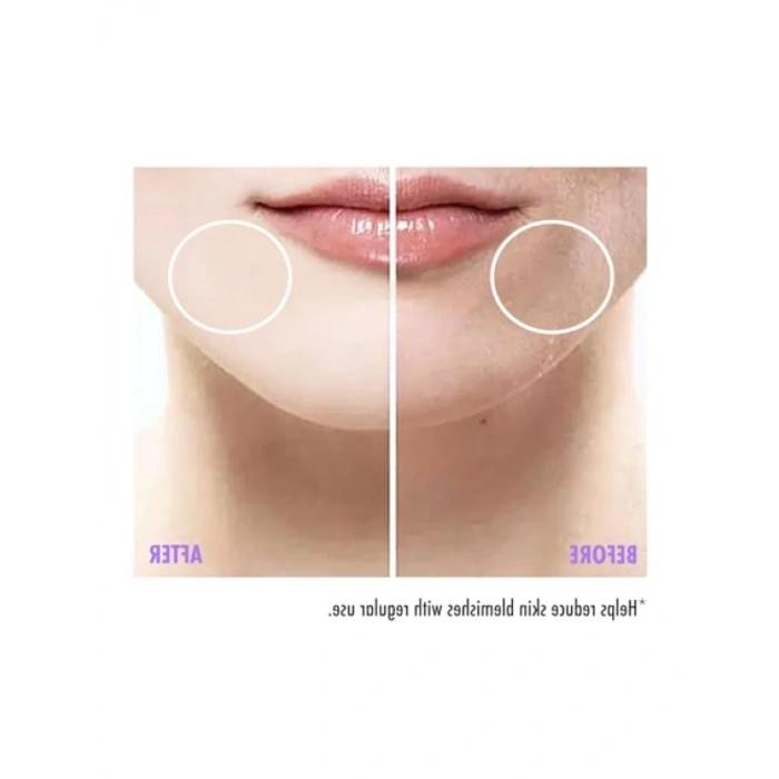 Leke Karşıtı Cilt Serumu - 30 ml